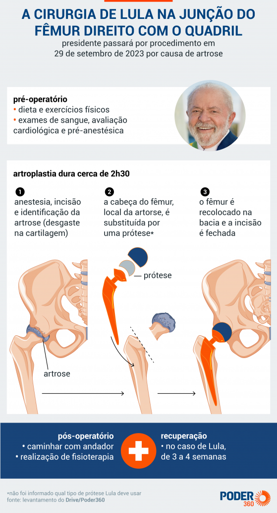 Lula faz cirurgia no quadril para corrigir artrose nesta 6ª feira